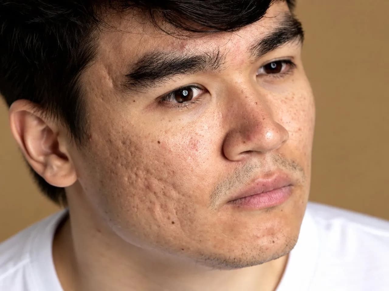 Doctor performing RF microneedling to improve acne scars