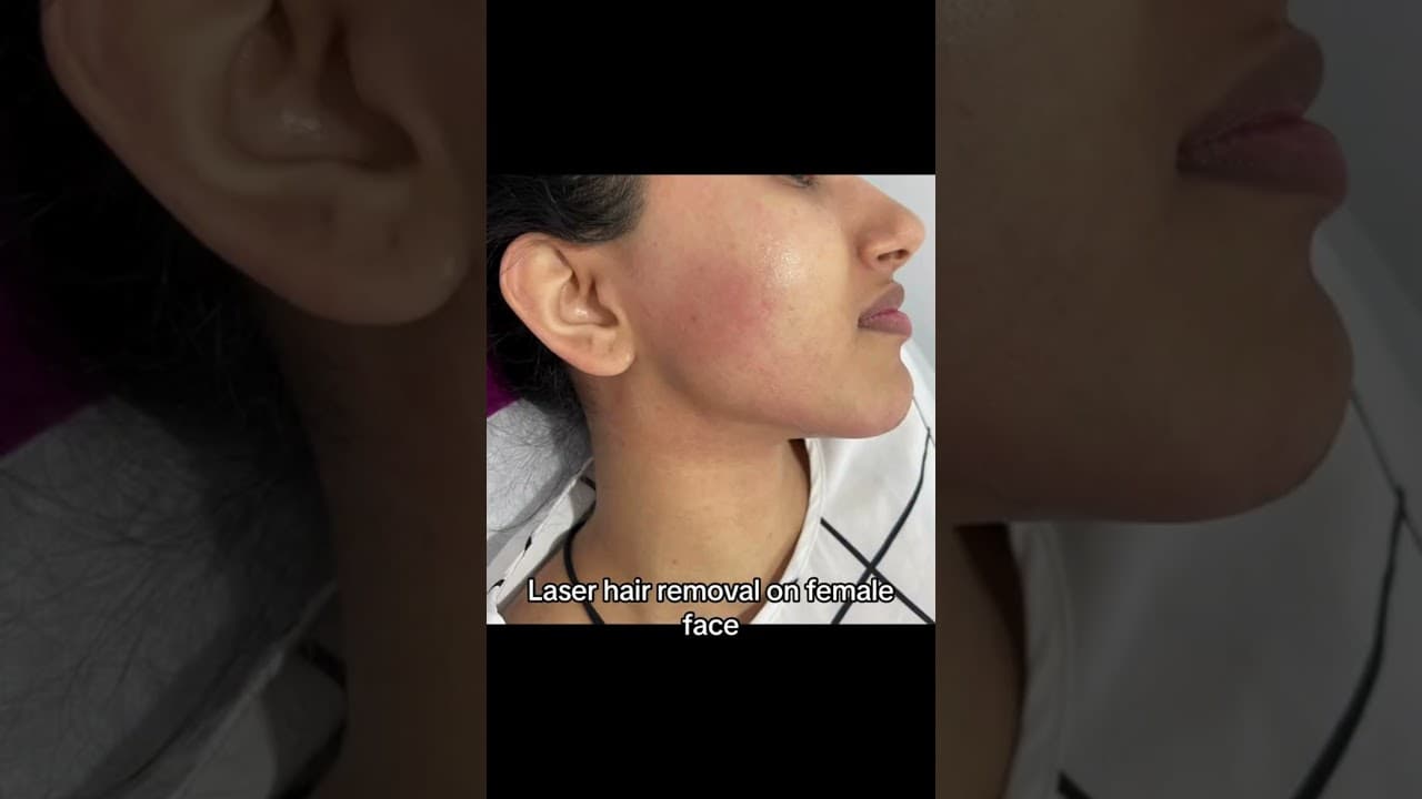You Won't Believe the Results of Laser Hair Removal at Paradise Wellness Delhi — video thumbnail