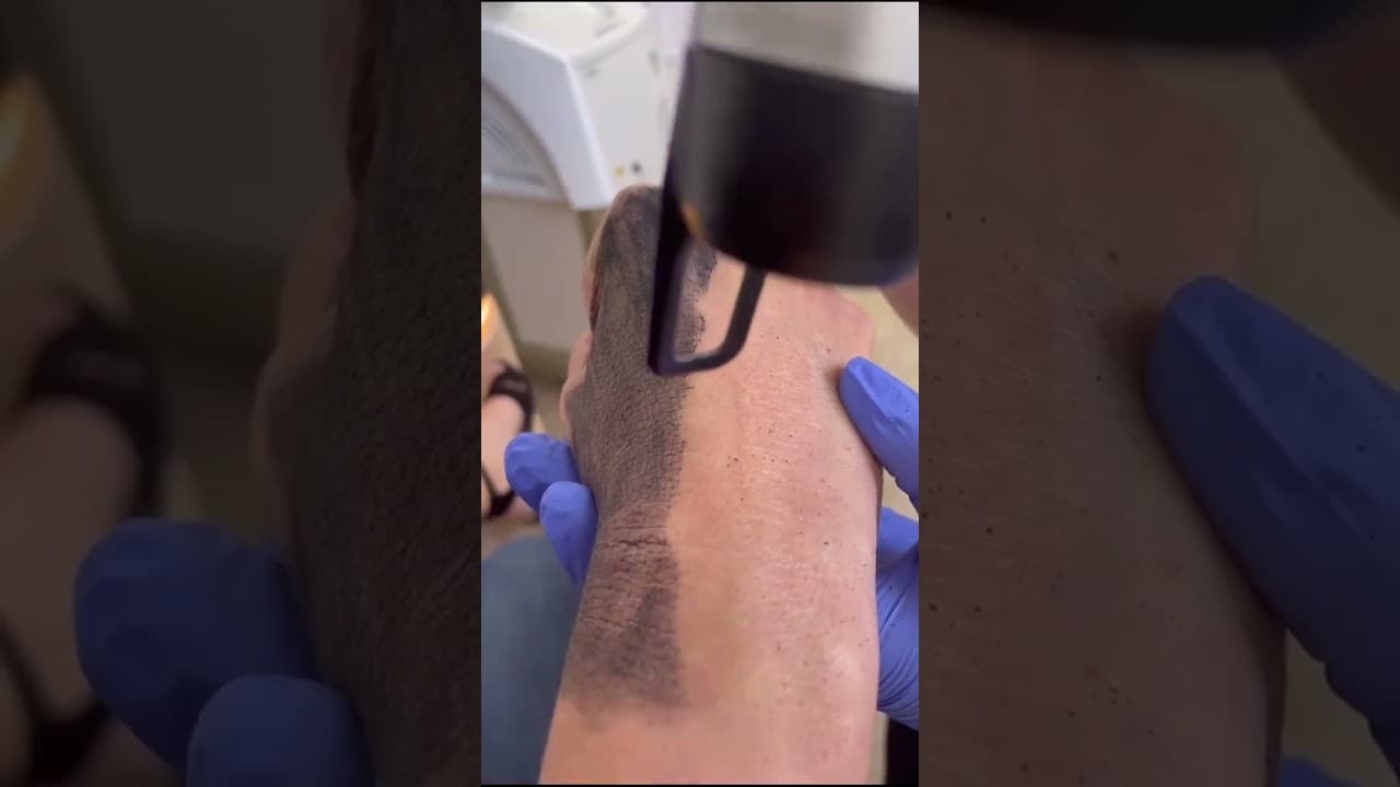 Best Tan Removal Facial for Hands | Carbon Laser Glow Treatment #carbonfacial #ipl #lasertoning — video thumbnail