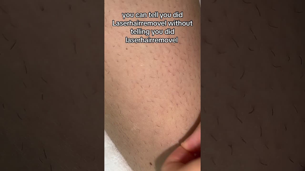Laser Hair Removal Shedding Phase Explained | What the Shadow Means After Laser Treatment #laser — video thumbnail