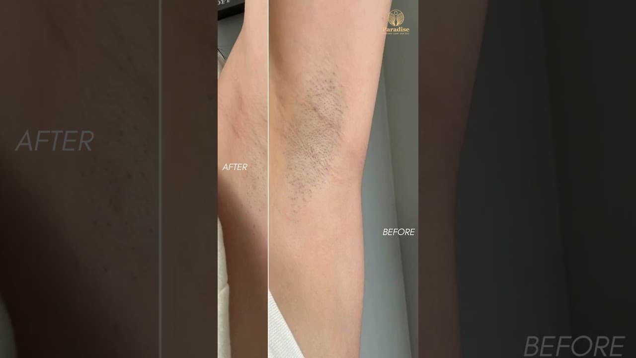 Underarm Laser Hair Removal 🔥 | Real Client Before & After | Painless & Permanent Results! — video thumbnail