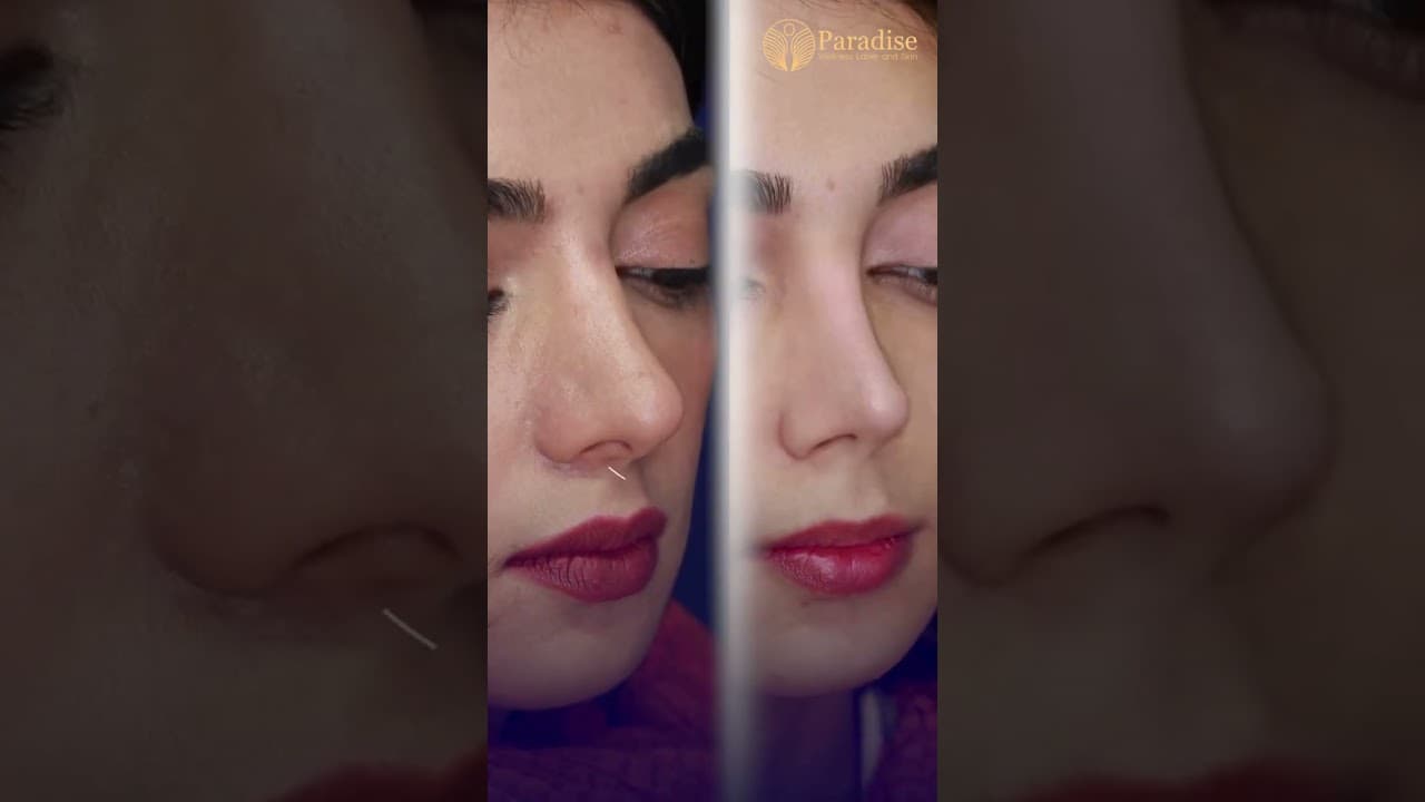 Hollywood-Style Rhinoplasty Surgary by Dr. Saman | Natural Nose in Delhi — video thumbnail