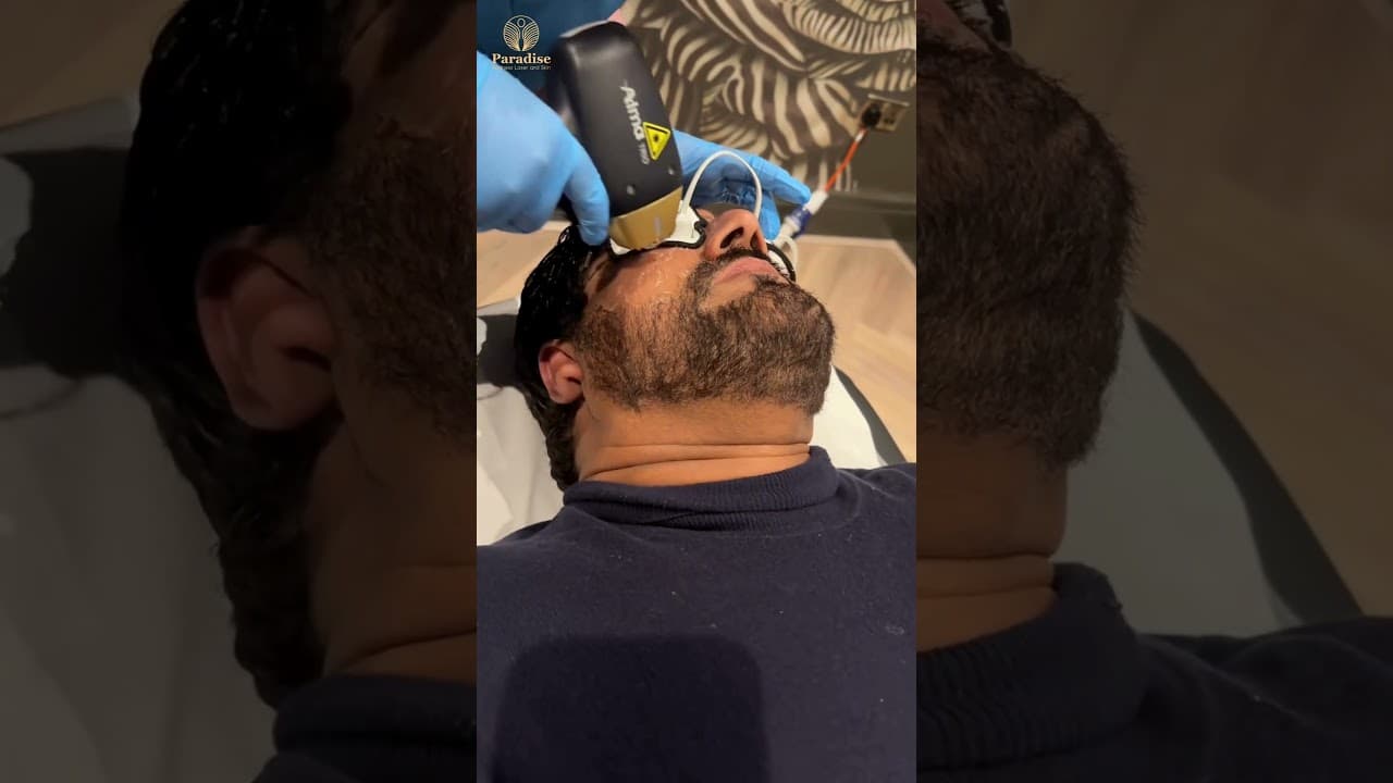 Face Laser Hair Removal for Men | Beard Shaping & Clean Look | Real Results at Paradise Wellness — video thumbnail