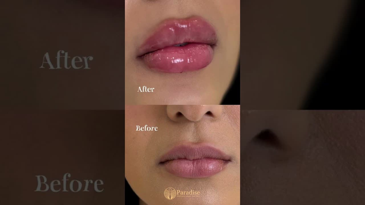 Round, Plump & Naturally Beautiful Lips! | Lip Filler Transformation at Paradise Wellness #lipfiller — video thumbnail