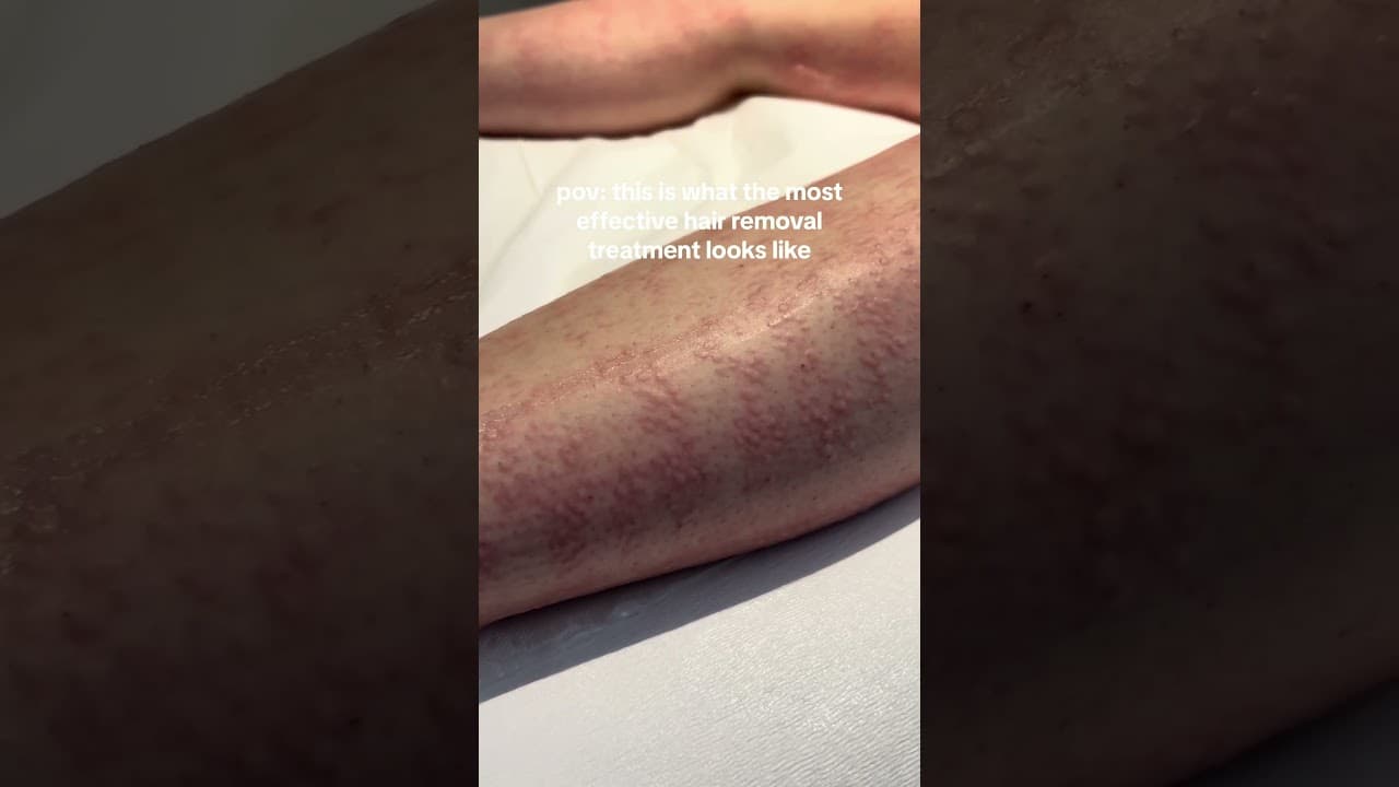 Redness After Laser Hair Removal? Here’s What It Really Means | Paradise Wellness Clinic — video thumbnail