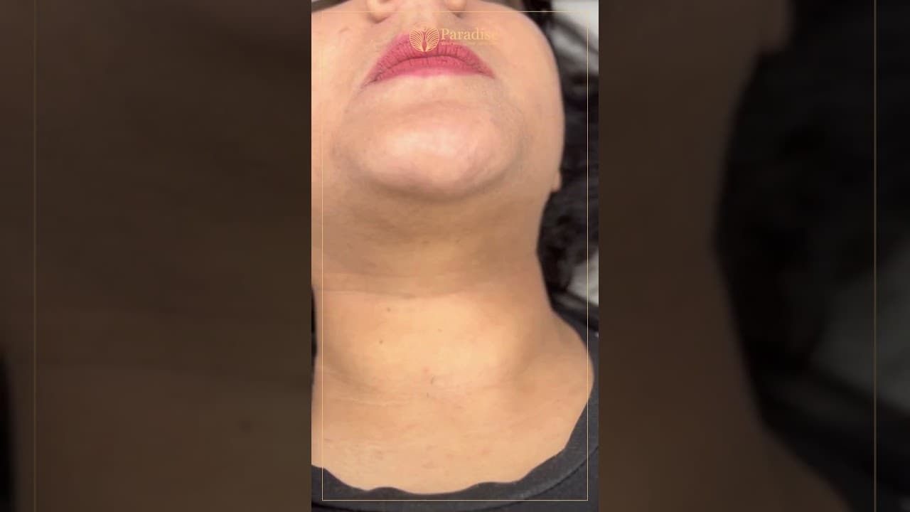 Best Laser Hair Removal in Delhi | Facial, Chin & Upper Lip Results — video thumbnail
