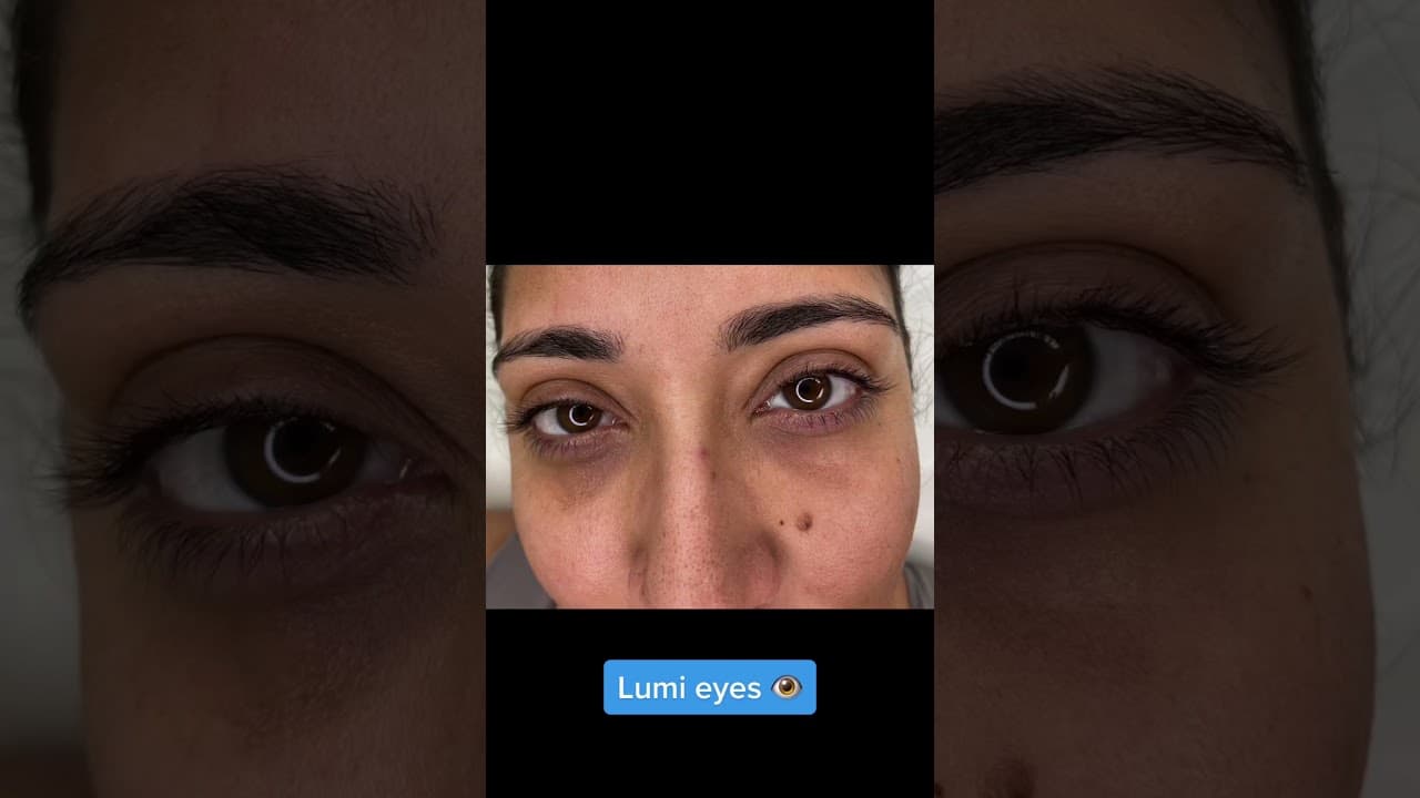 Lumi Eye Treatment EXPOSED My Shocking Results — video thumbnail