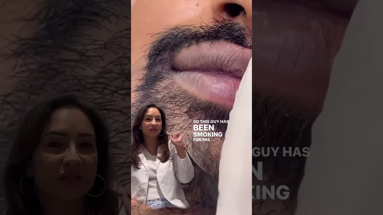💋 Say Goodbye to Smoker’s Lips! Skin Boosters for Smooth Lips | Best Luxury Clinic in Delhi No.1 — video thumbnail