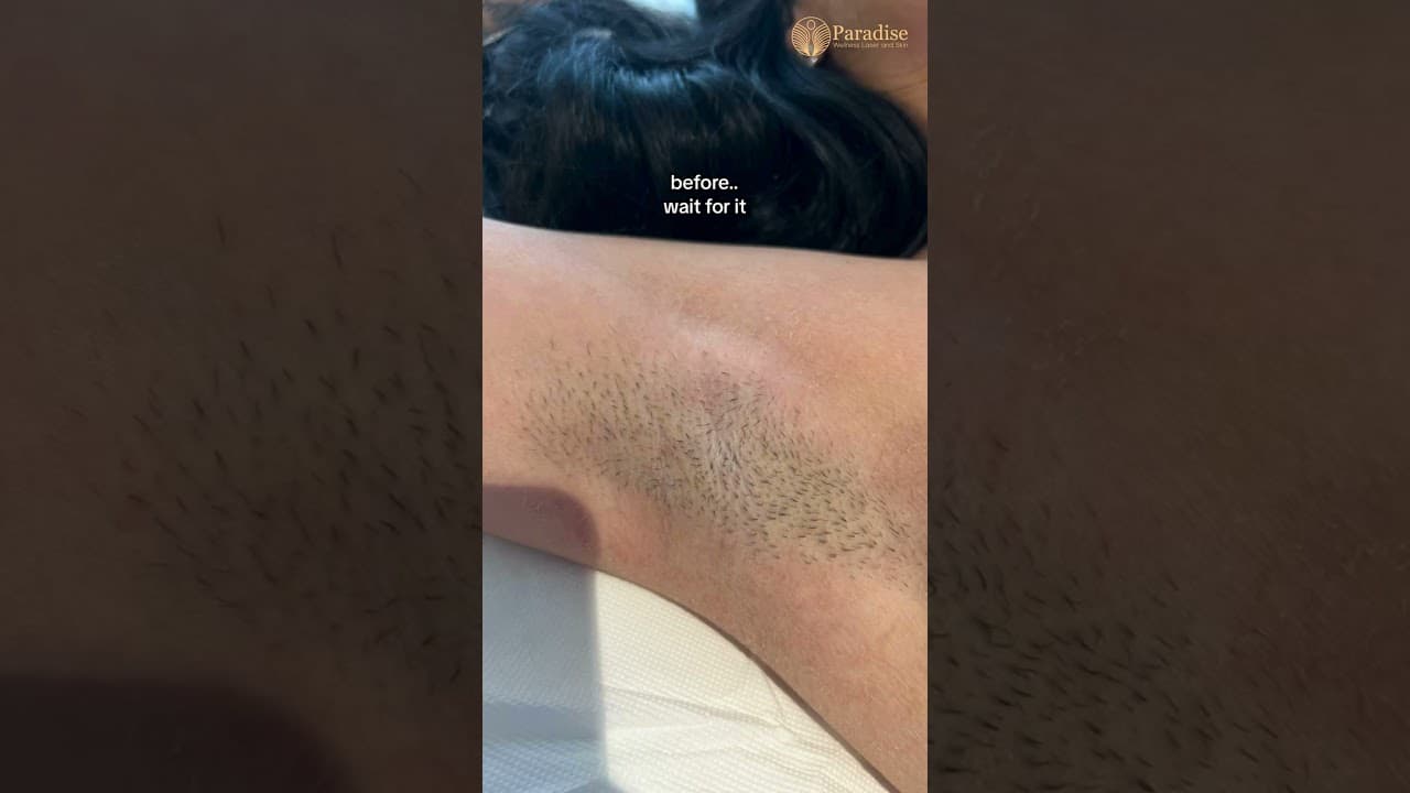 Underarm Laser Hair Removal | Alma Soprano Titanium Results Delhi — video thumbnail