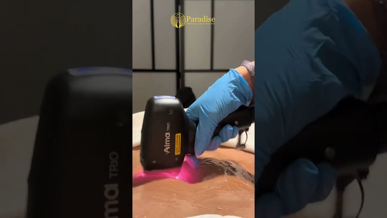 Tommy Laser Hair Removal with Alma Soprano Titanium | Pain-Free, Fast & Permanent Results — video thumbnail