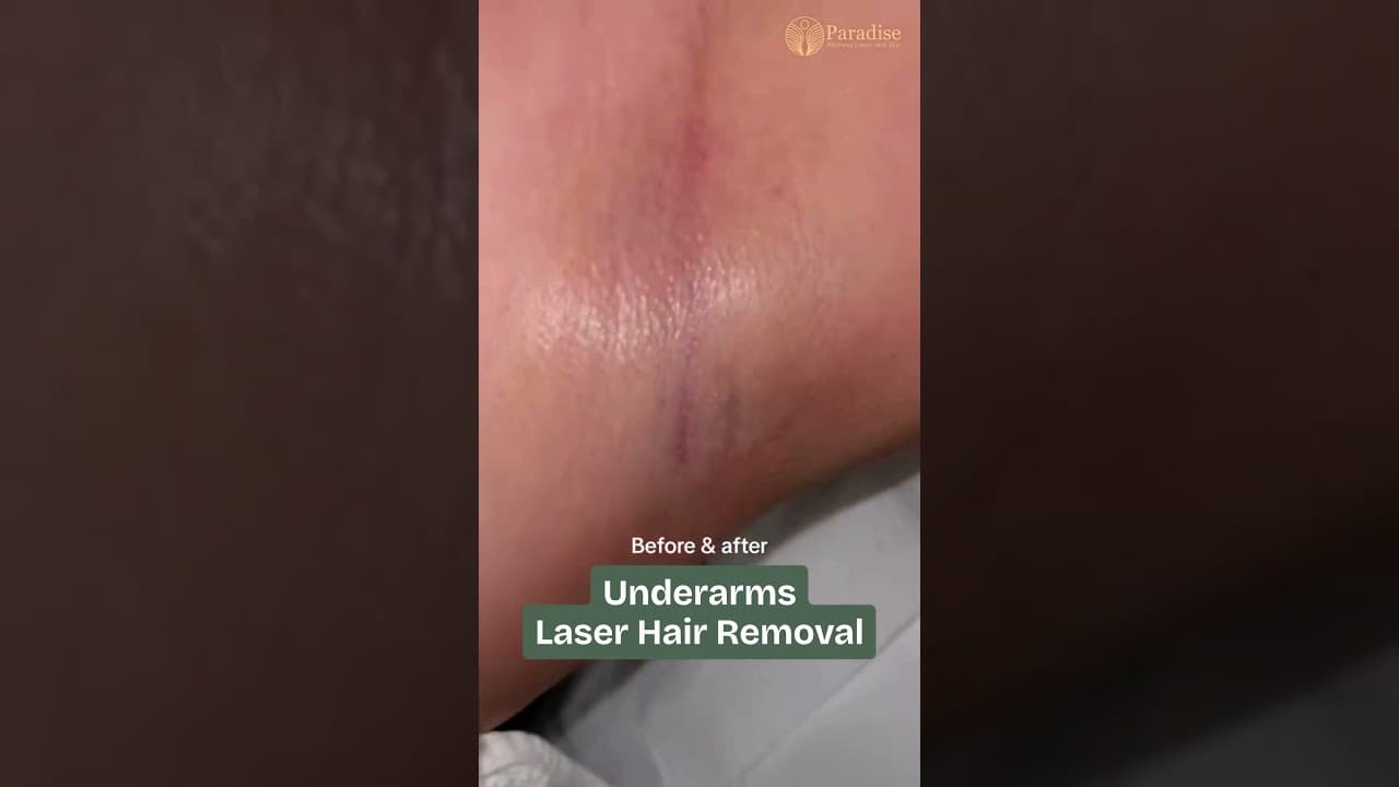 Underarm Laser with Alma Soprano Titanium | Real Before & After in Delhi — video thumbnail