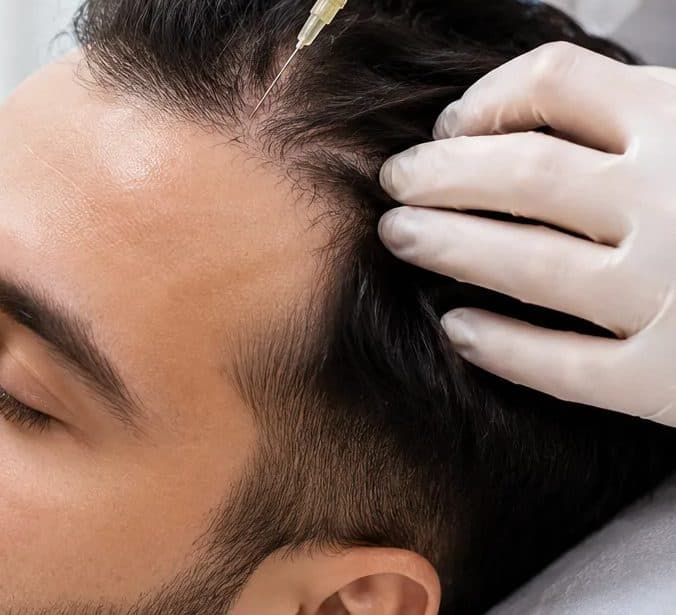 GFC & PRP for Hair for hair fall & thinning at Paradise Wellness