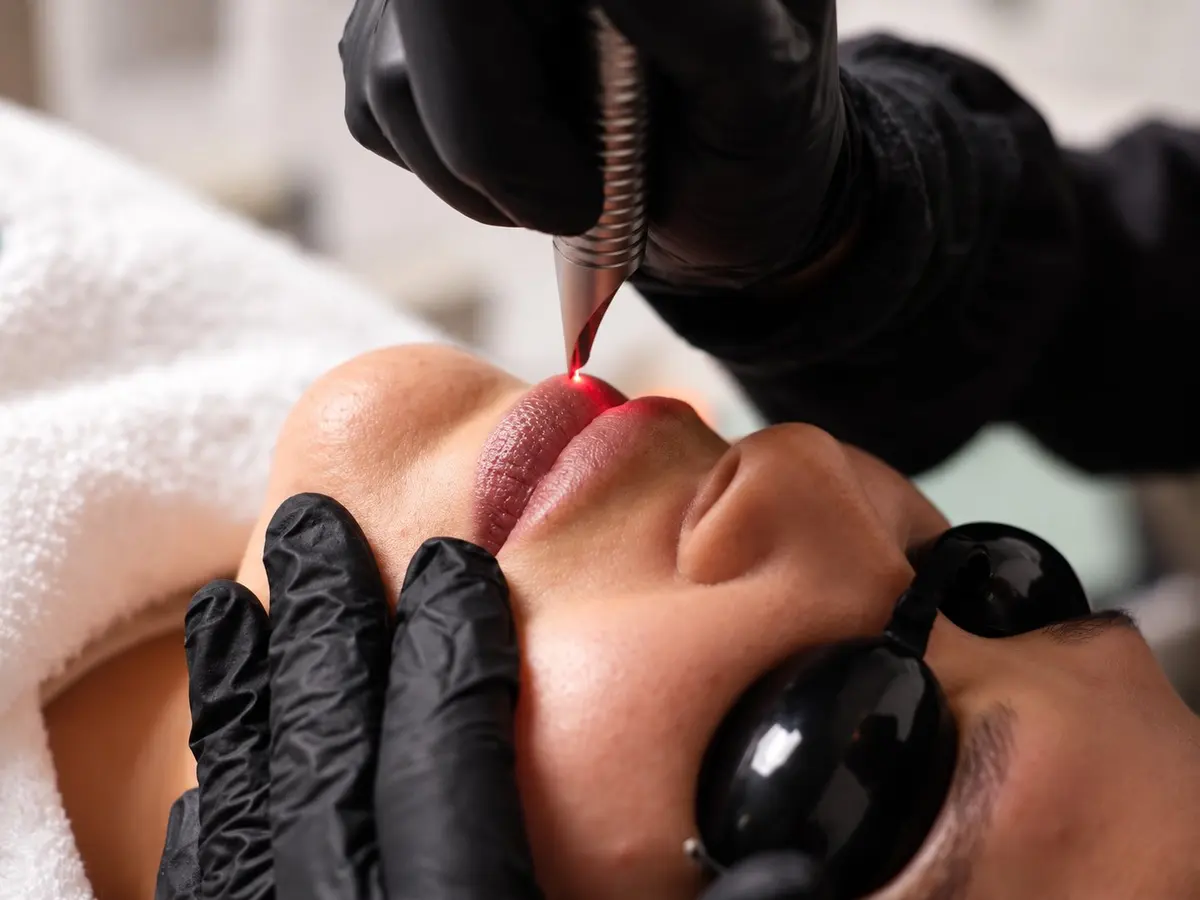 Lip Laser Toning at Paradise Wellness
