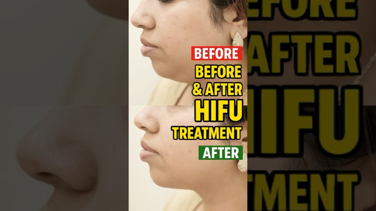 Double Chin? Gone. Jawline? Snatched 💁♀️ | My HIFU Glow-Up Experience in Delhi (Before & After) — video thumbnail