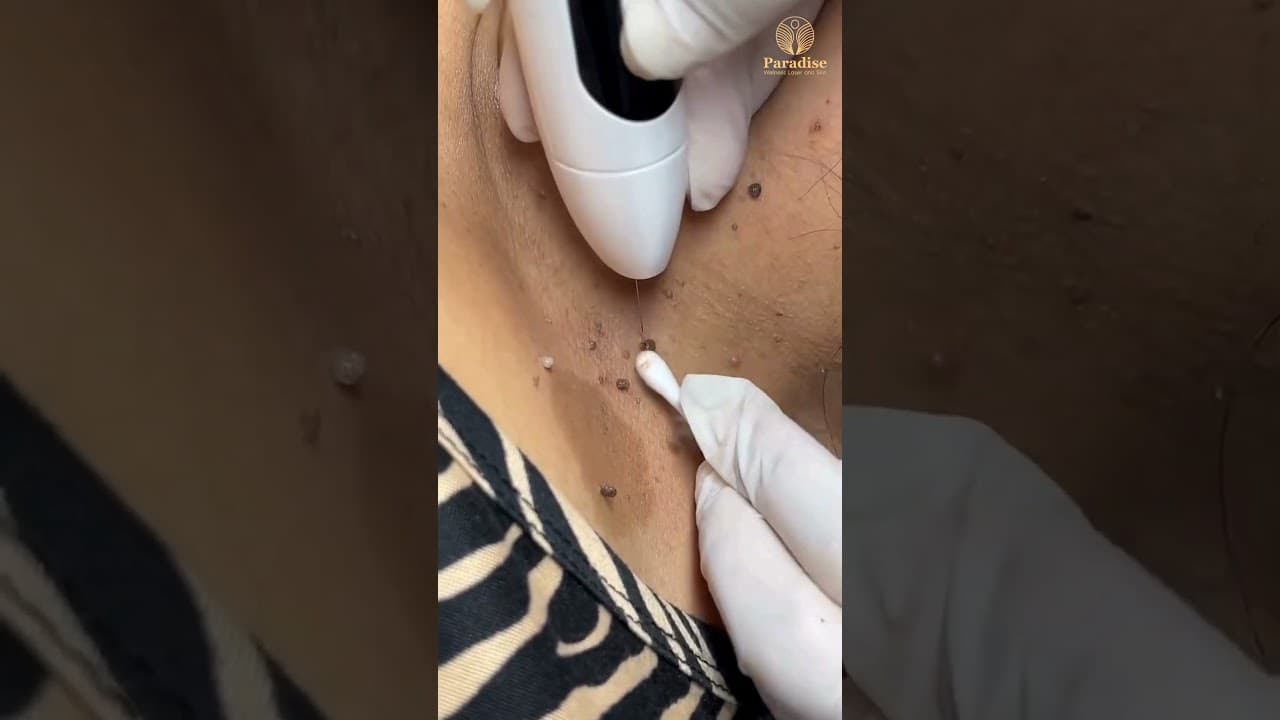 Mole Removal Treatment at Paradise Wellness — video thumbnail