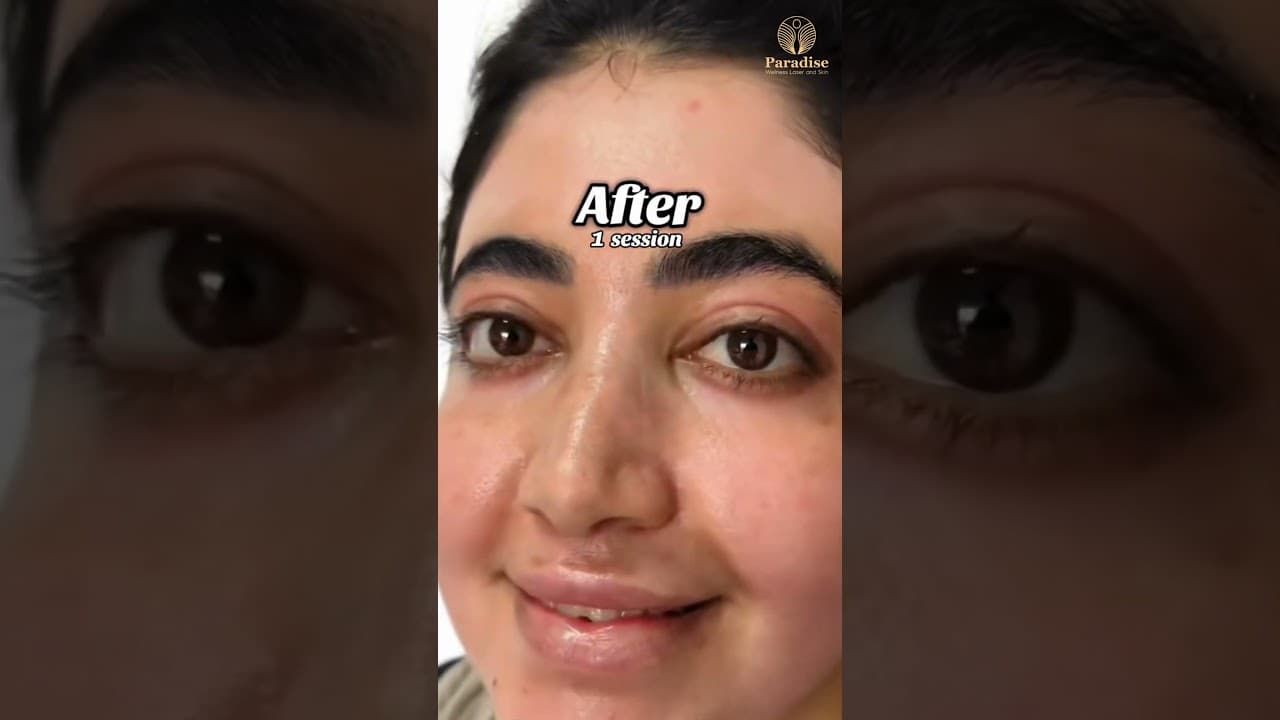 1 Anti-Aging Treatmnt = Instant Glow-Up | Real Client Before & After | Paradise Wellness — video thumbnail