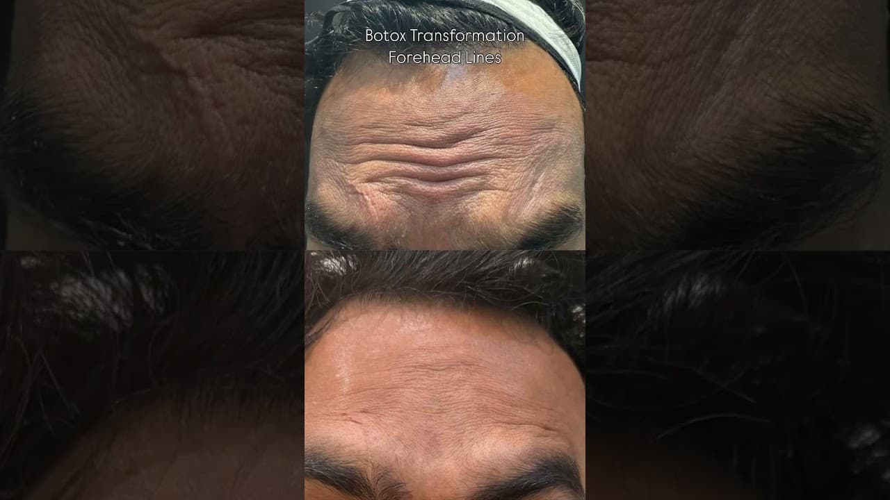 Botox for Forehead Wrinkles Instant Anti-Aging Treatment Before & After Transformation #botox — video thumbnail