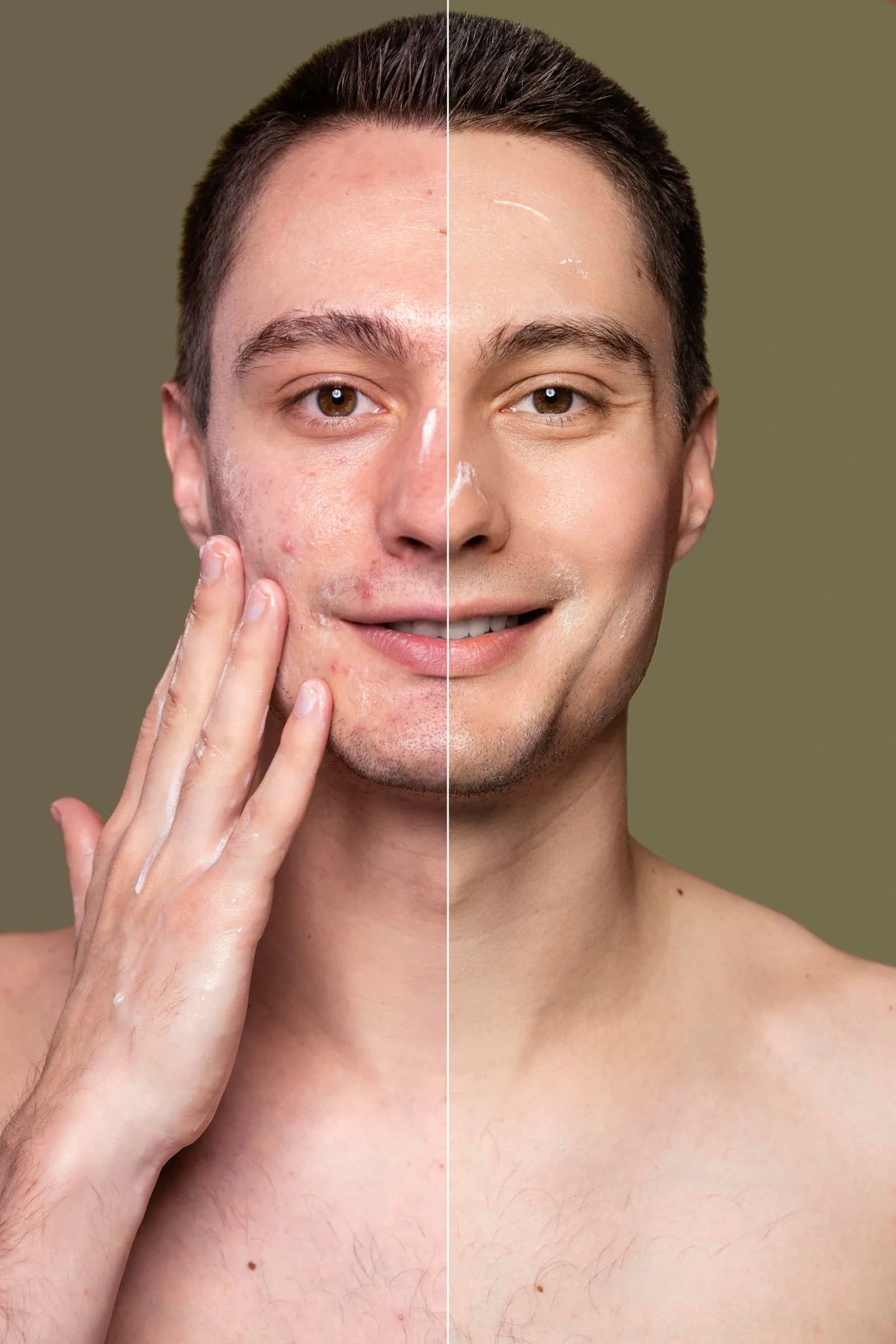 BioRePeel Vs Chemical Peels Which One is Better lets check our blog
