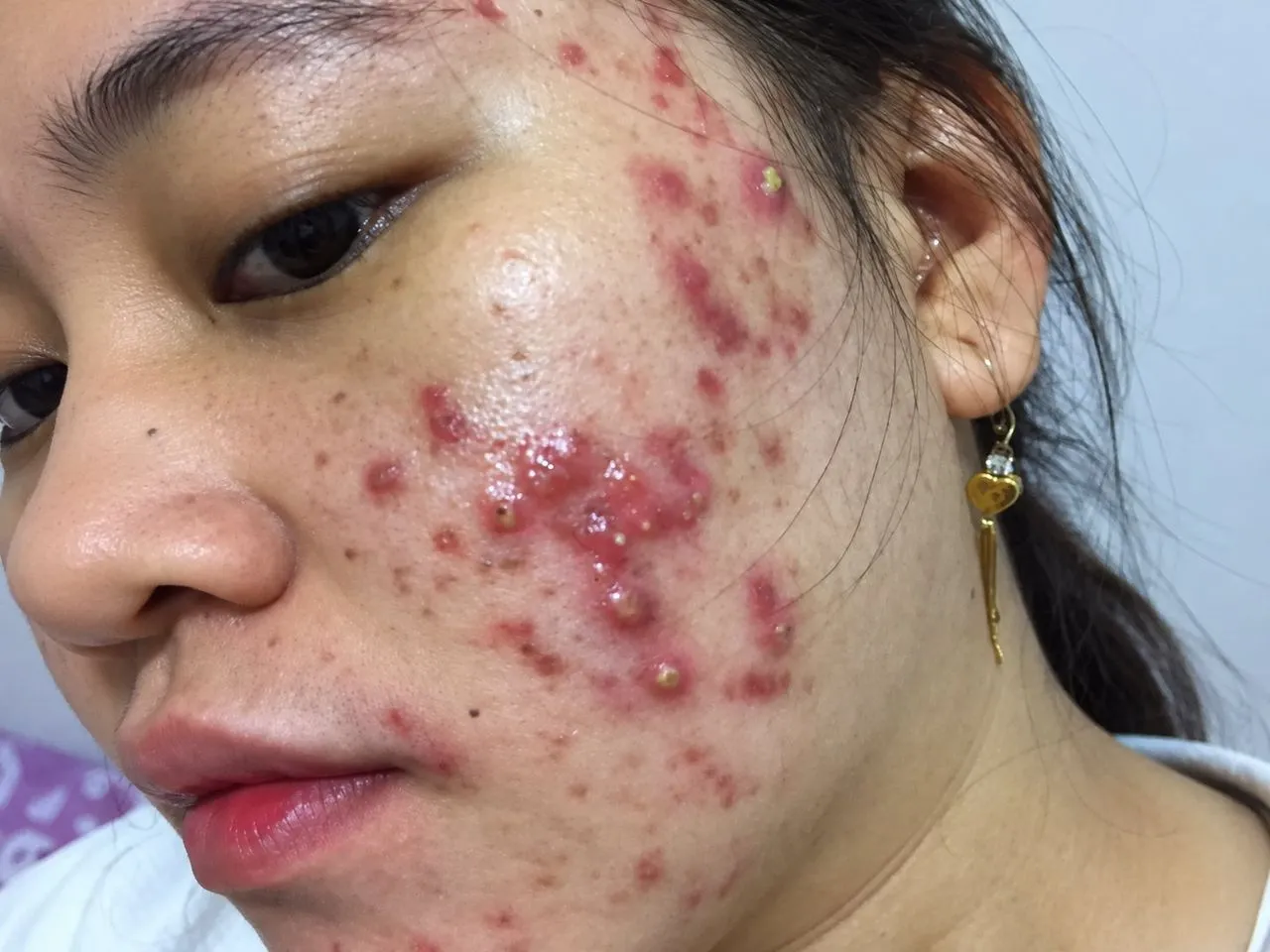 Carbon laser peel being performed for oily, acne-prone skin