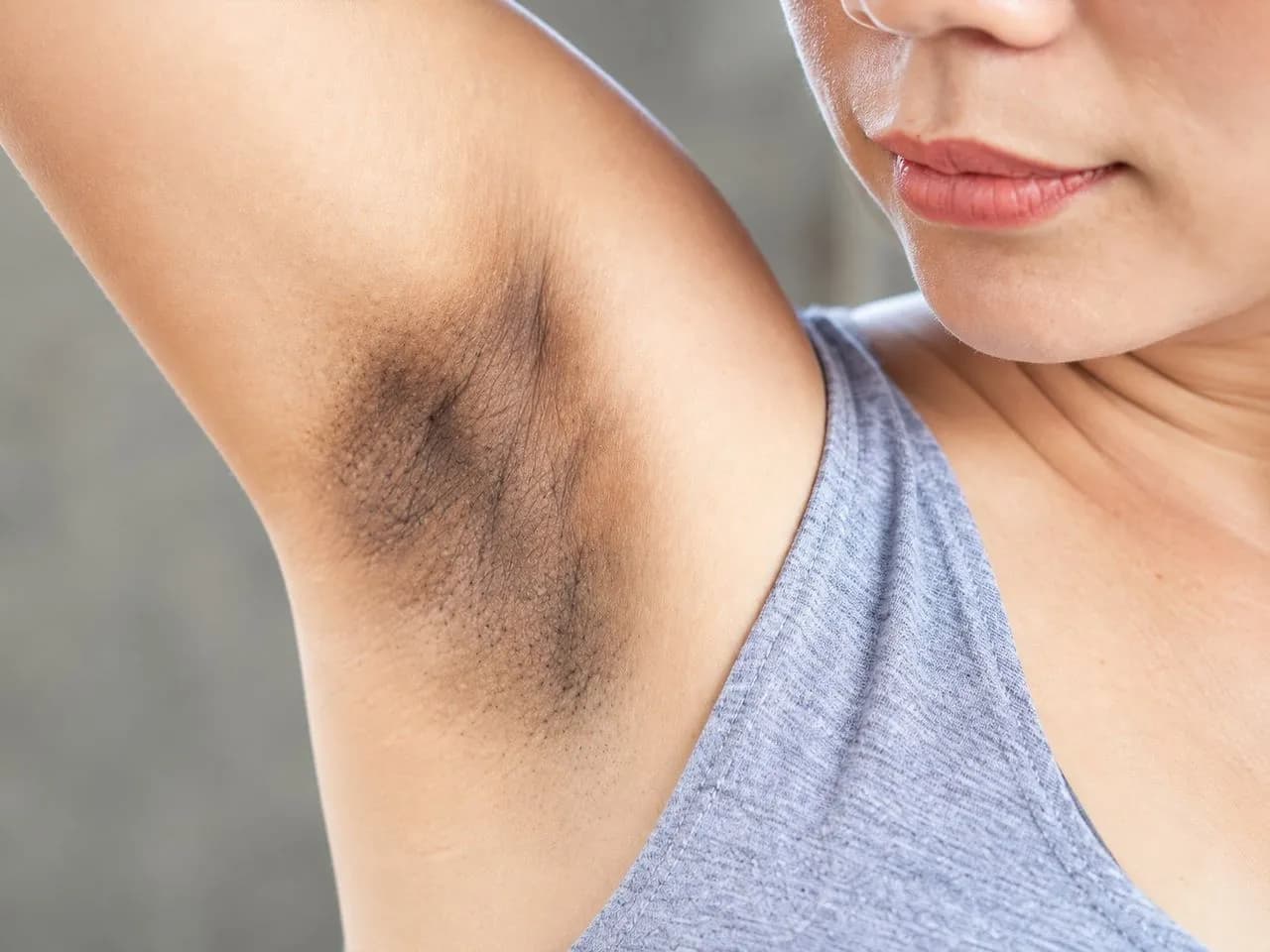Laser toning treatment for dark underarms
