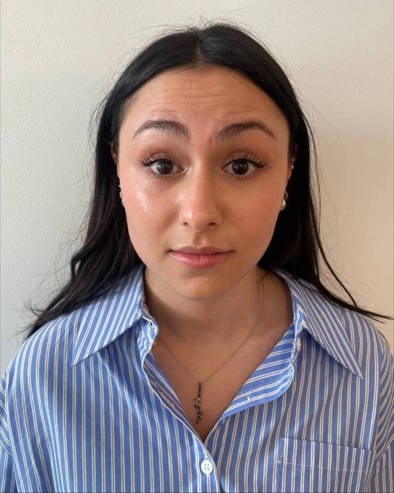Before Botox: Forehead Botox After 100 Units