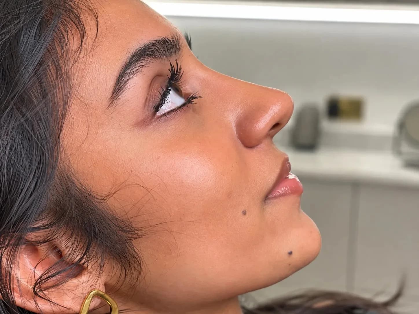 After Dermal & Lip Fillers: Nose Filler Before & After – Natural Nose Contouring