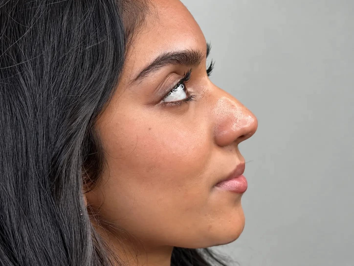 Before Dermal & Lip Fillers: Nose Filler Before & After – Natural Nose Contouring