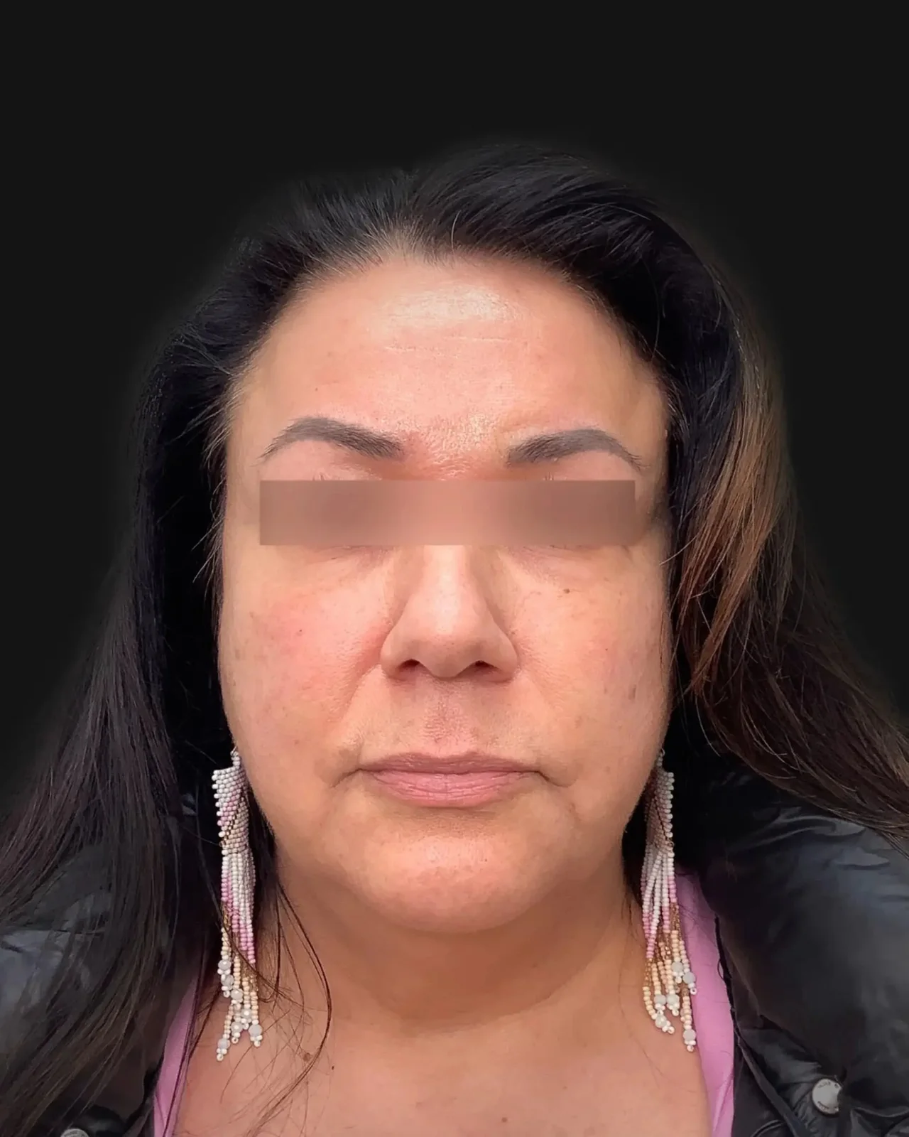 After Dermal & Lip Fillers: Under-Eye Tear Trough Filler Before & After