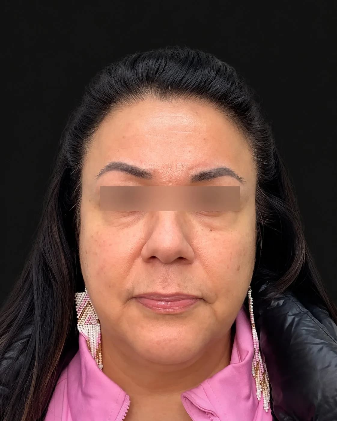 Before Dermal & Lip Fillers: Under-Eye Tear Trough Filler Before & After