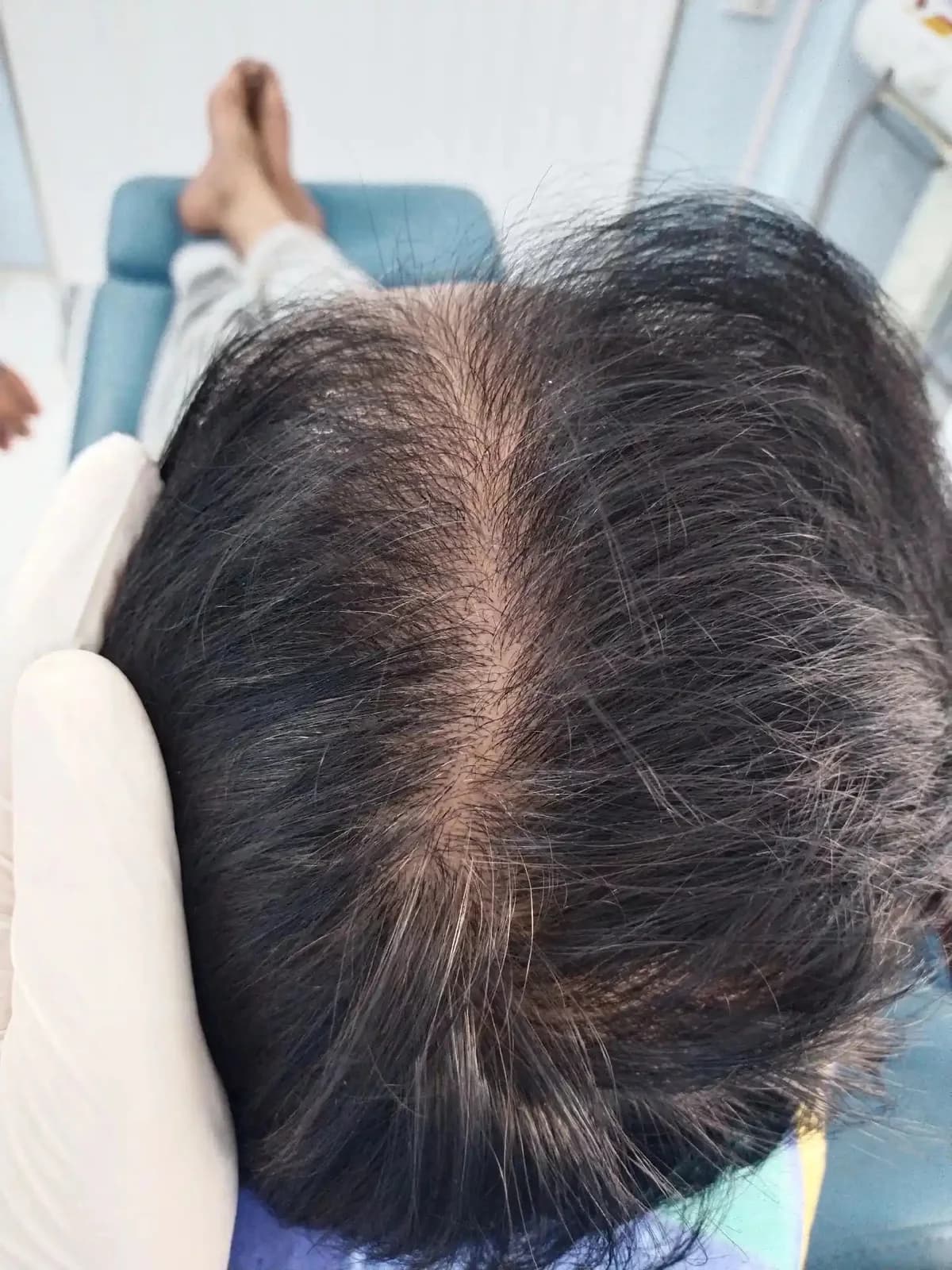 Before GFC & PRP hair treatment showing the client’s hair and scalp condition prior to treatment.