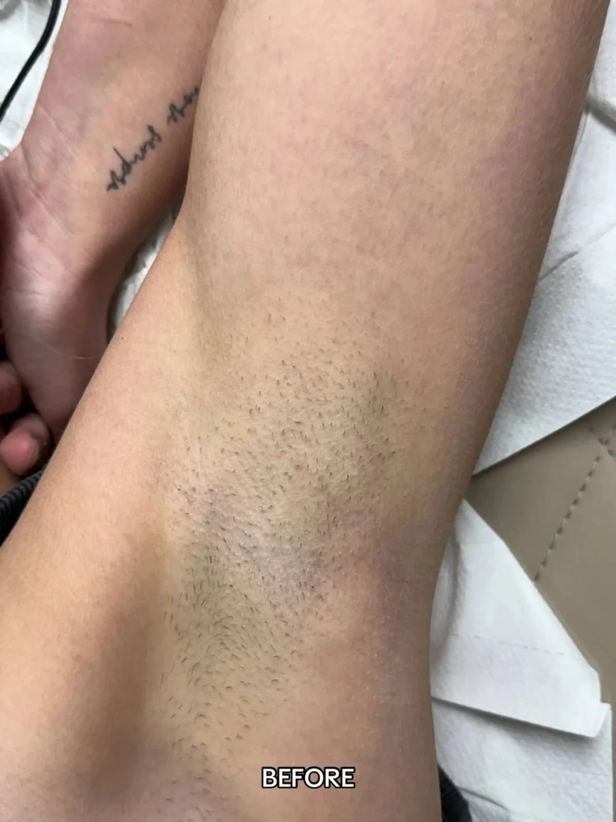 Before photo showing underarm hair growth prior to laser hair removal treatment at Paradise Wellness, Vasant Vihar.