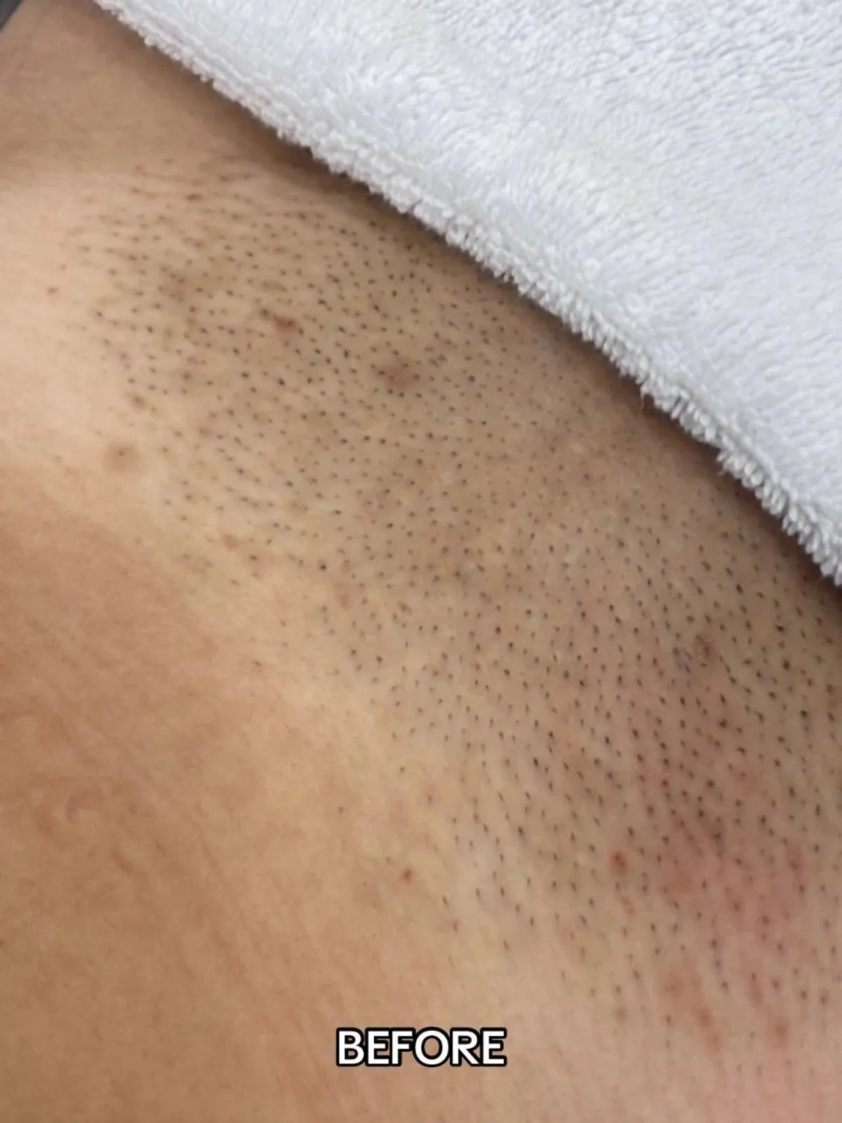 Before photo of underarm hair growth prior to laser hair removal treatment at Paradise Wellness, Vasant Vihar.