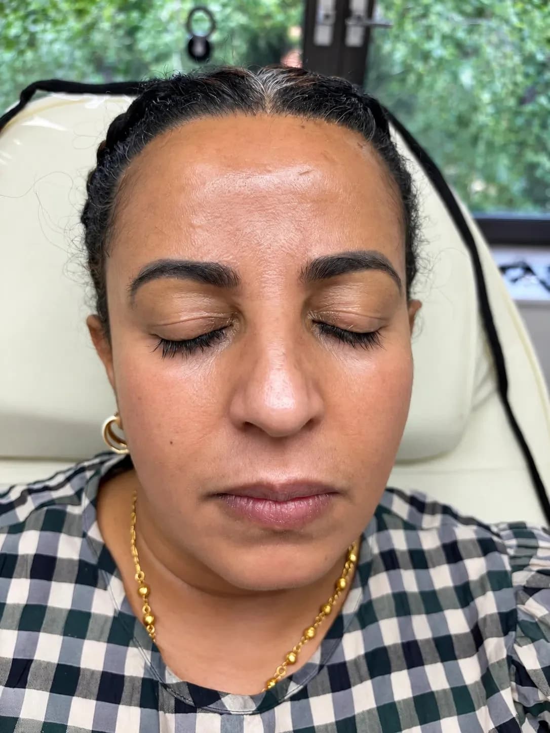 Cosmelan Peel after treatment showing improved facial pigmentation and more even skin tone