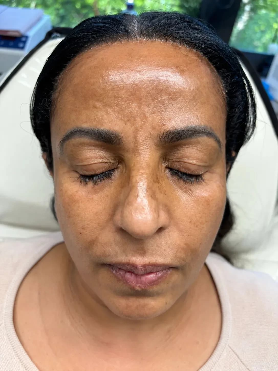 Cosmelan Peel before treatment for facial pigmentation and uneven skin tone