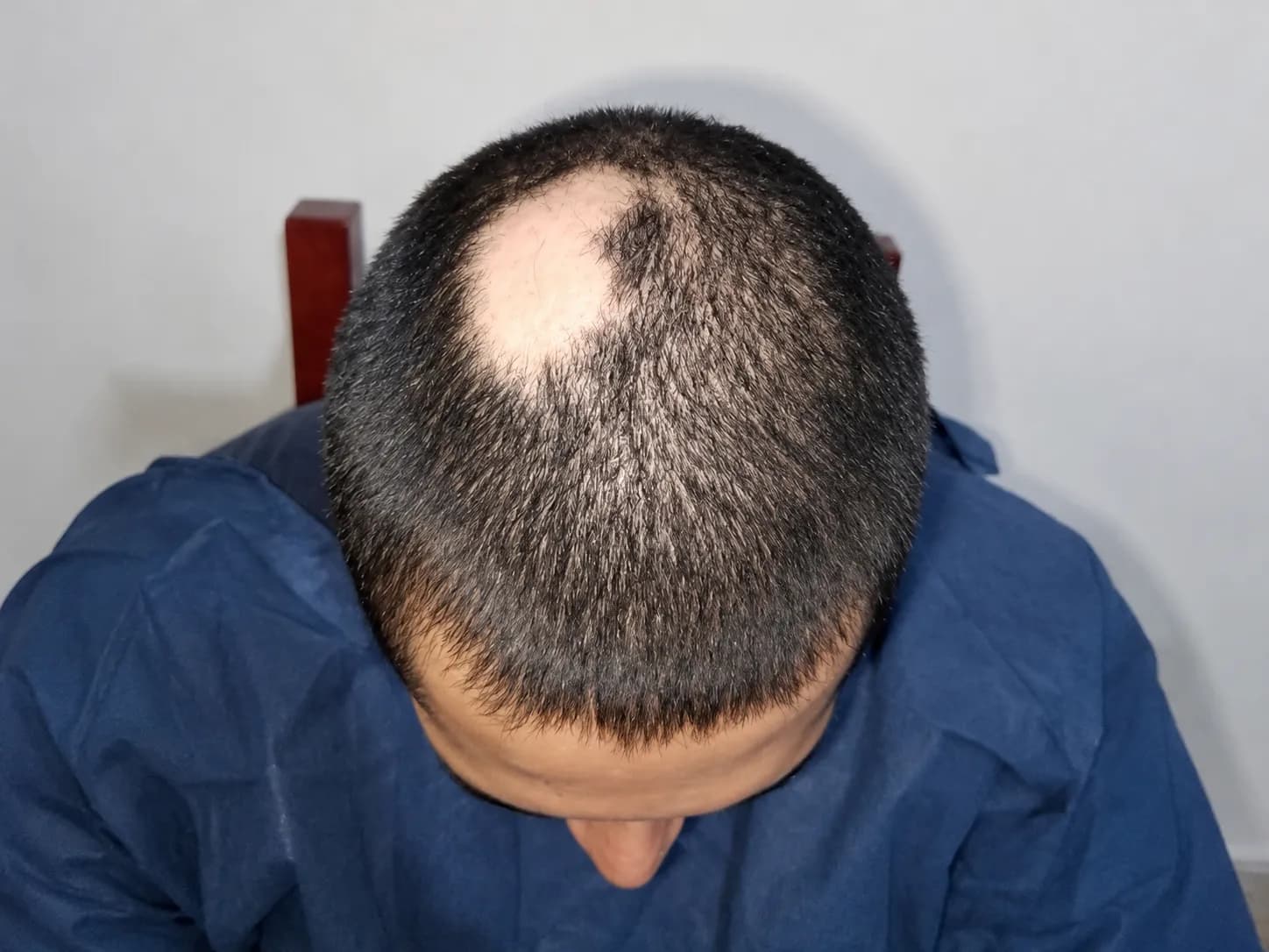 Visible patchy hair loss on the scalp associated with alopecia