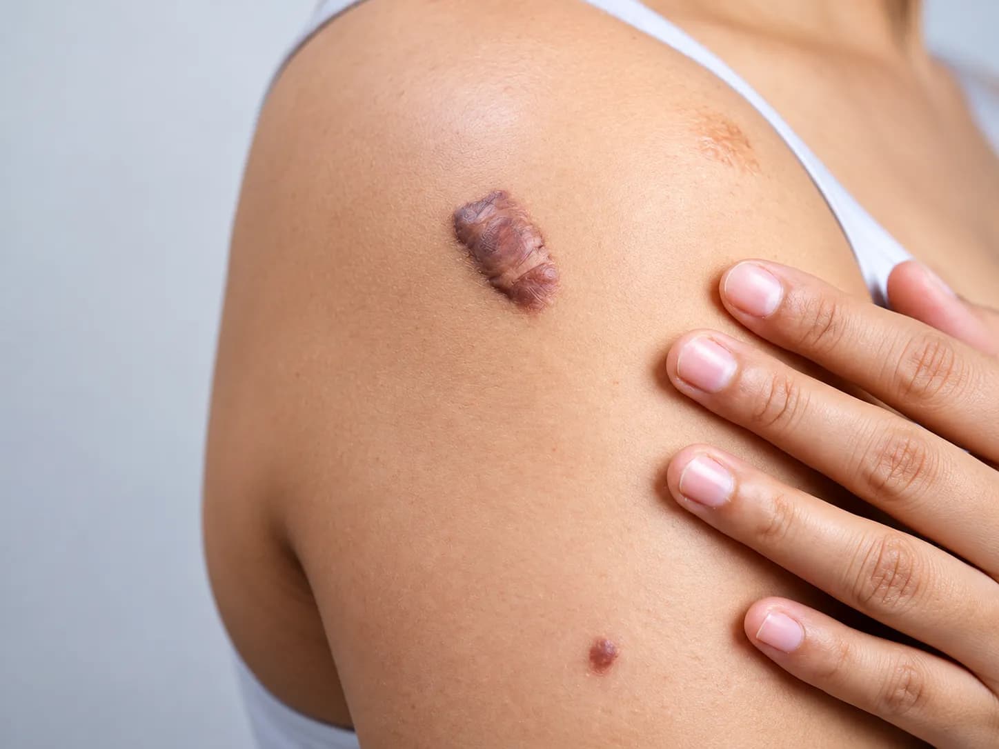 Keloid and raised scar treatment for improving the appearance of thickened scars