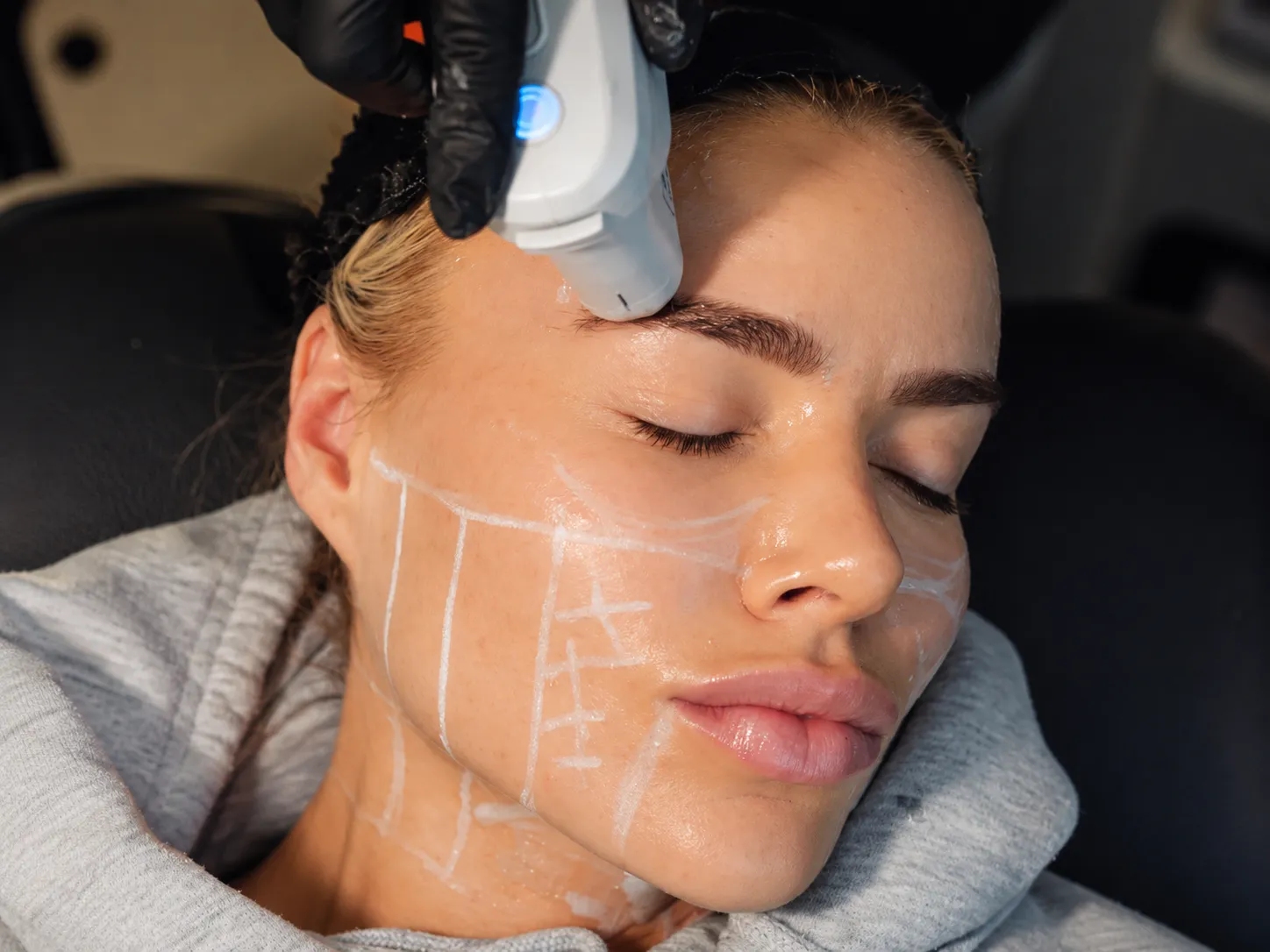 Skin tightening treatment to improve the appearance of skin firmness and elasticity