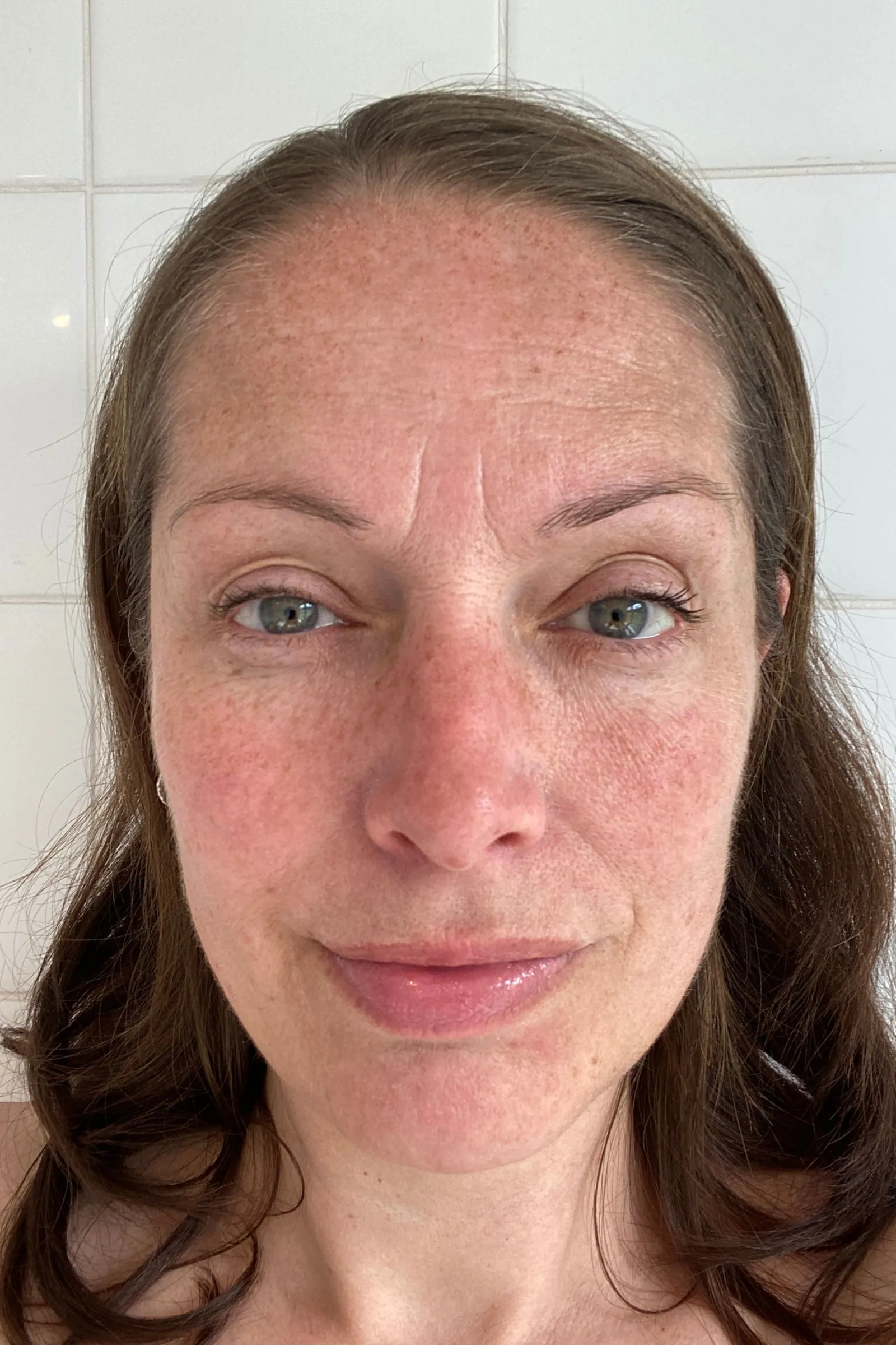 Before and after pigmentation treatment results on Indian skin at Paradise Wellness Clinic