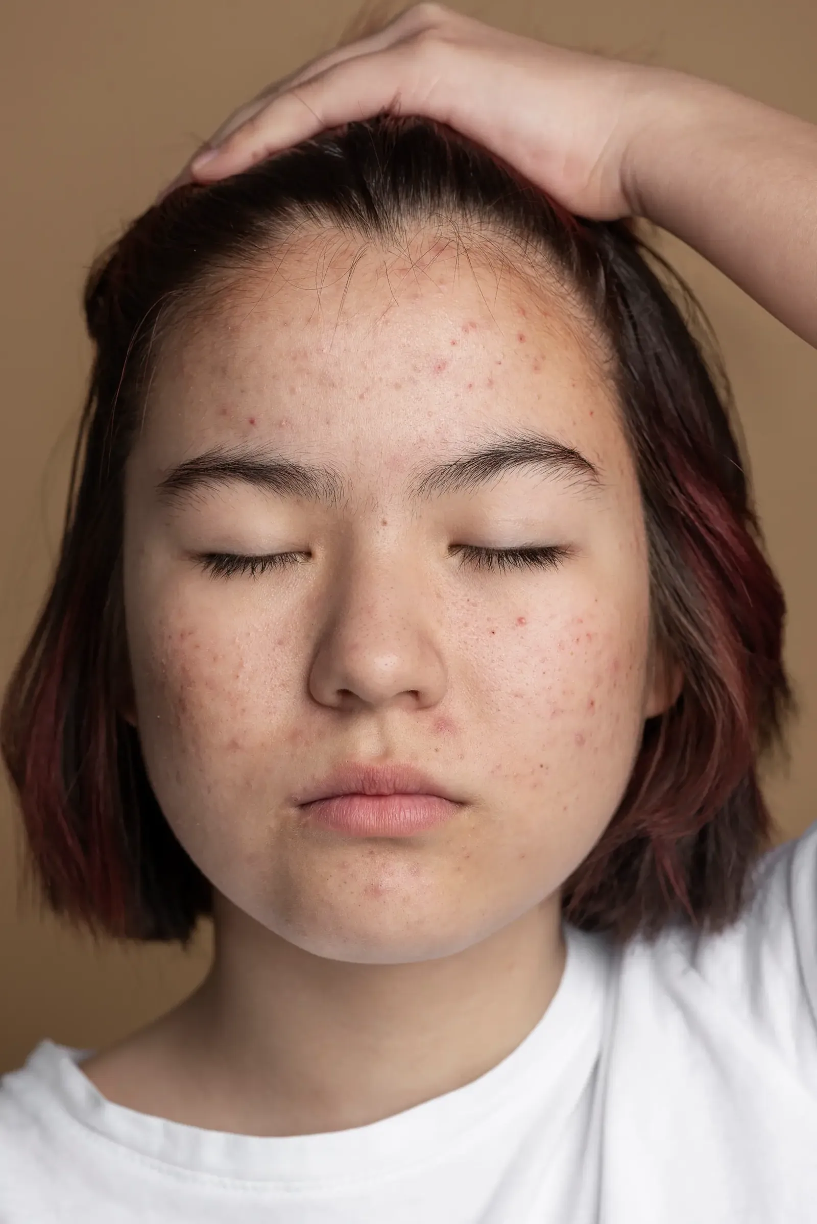 Best Treatments for Open Pores in India