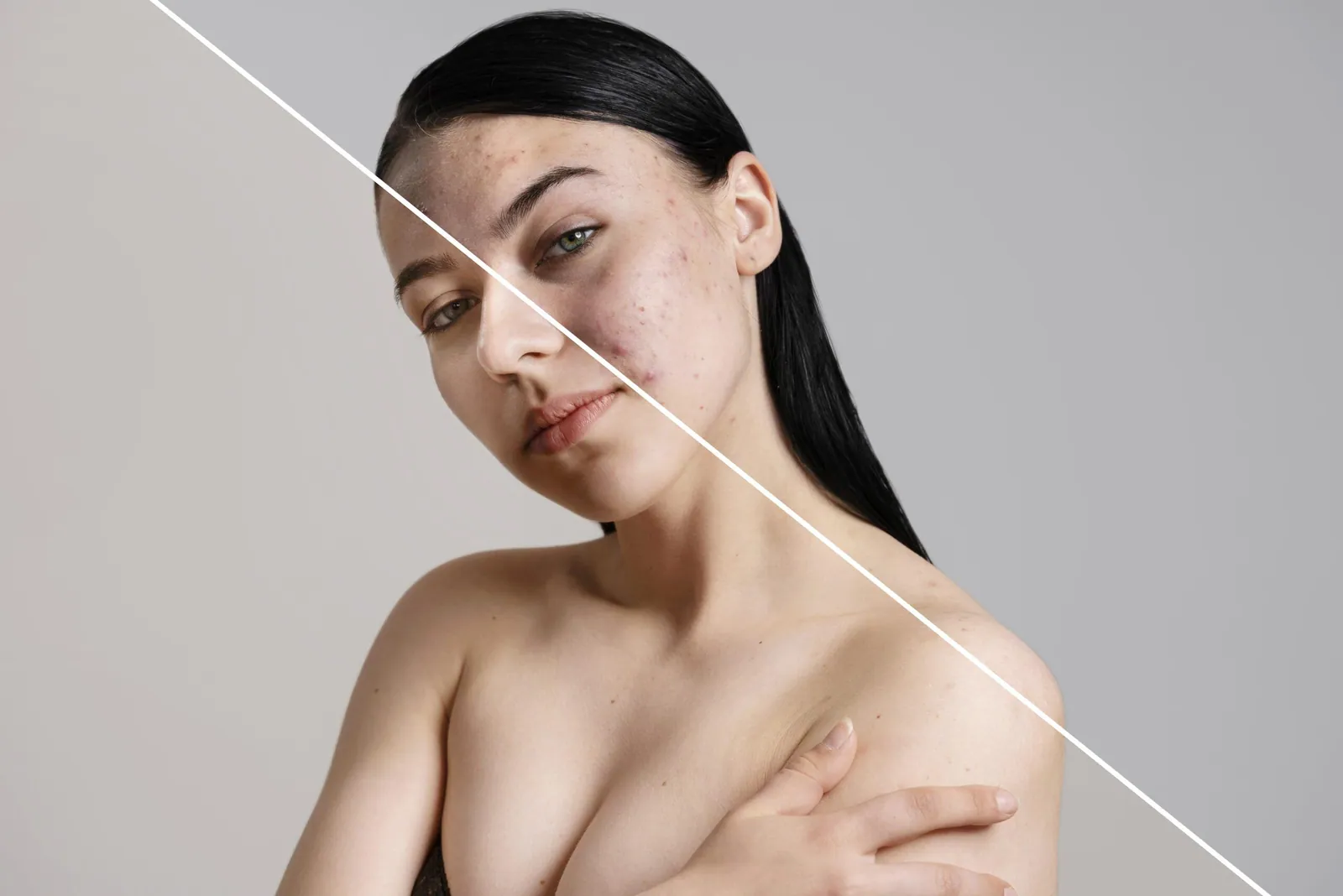 Cosmelan Peel for Pigmentation women before and after image