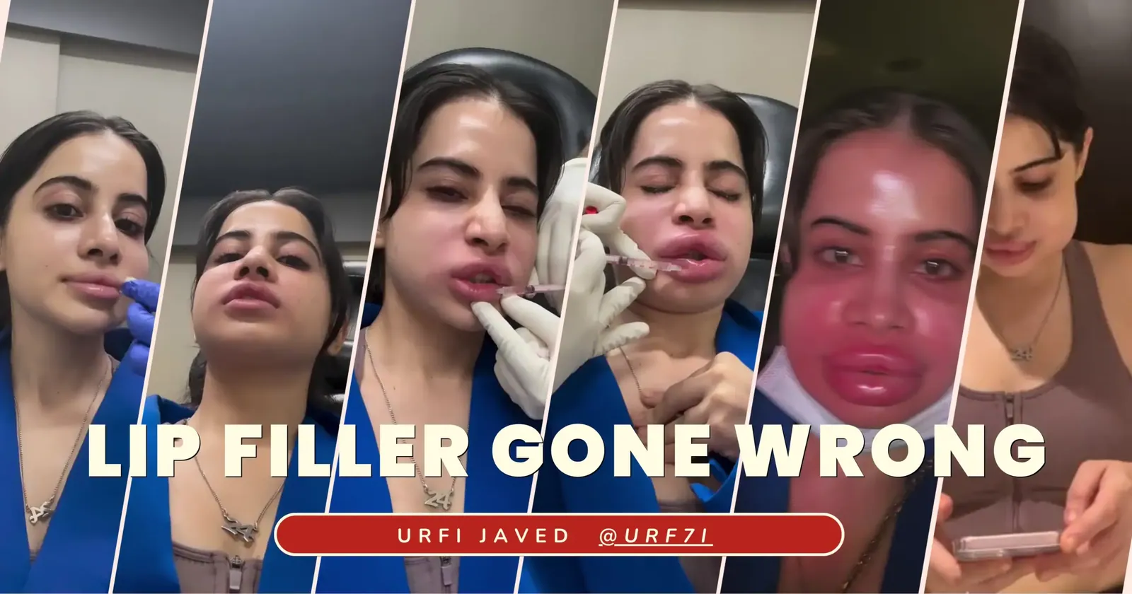 Urfi Javed: Uorfi Javed gets her lip fillers dissolved after 9 years, shares pictures of her swollen face
