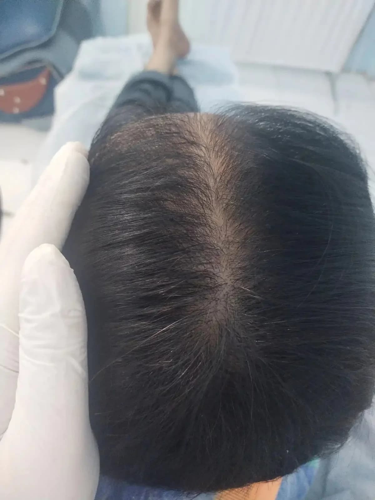 After 6 sessions of GFC & PRP hair treatment over 6 months, showing the client’s hair and scalp condition in a comparable view.