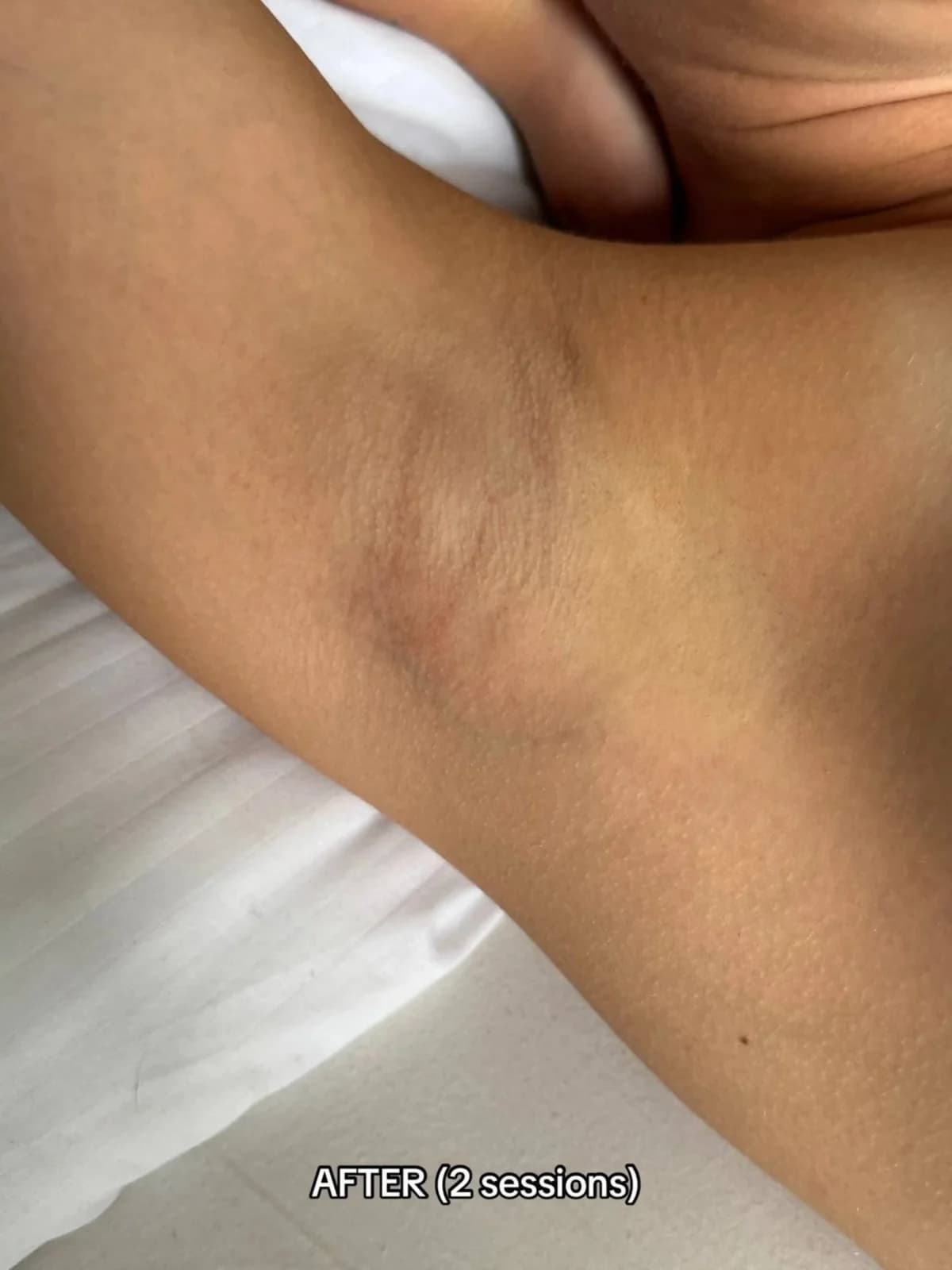 After photo showing reduced underarm hair growth following 3 laser hair removal sessions at Paradise Wellness, Vasant Vihar.