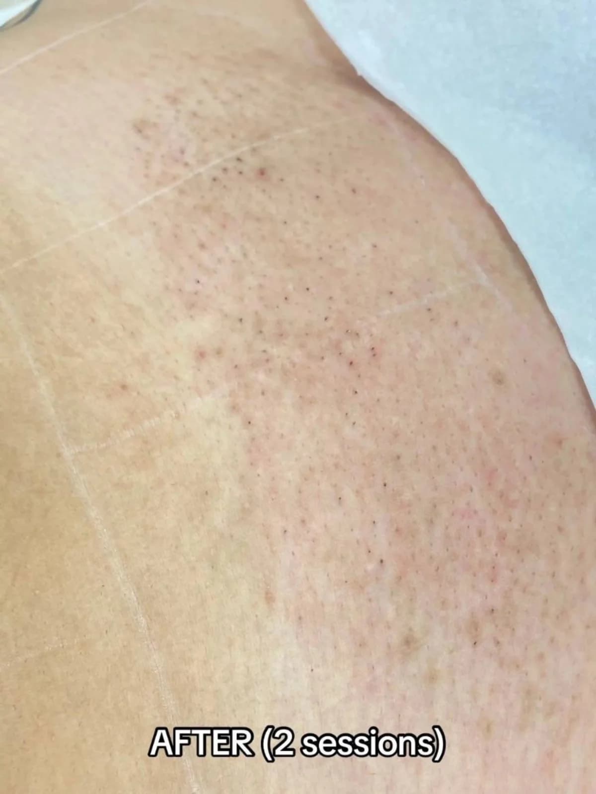After photo showing reduced underarm hair growth following 3 laser hair removal sessions at Paradise Wellness, Vasant Vihar.