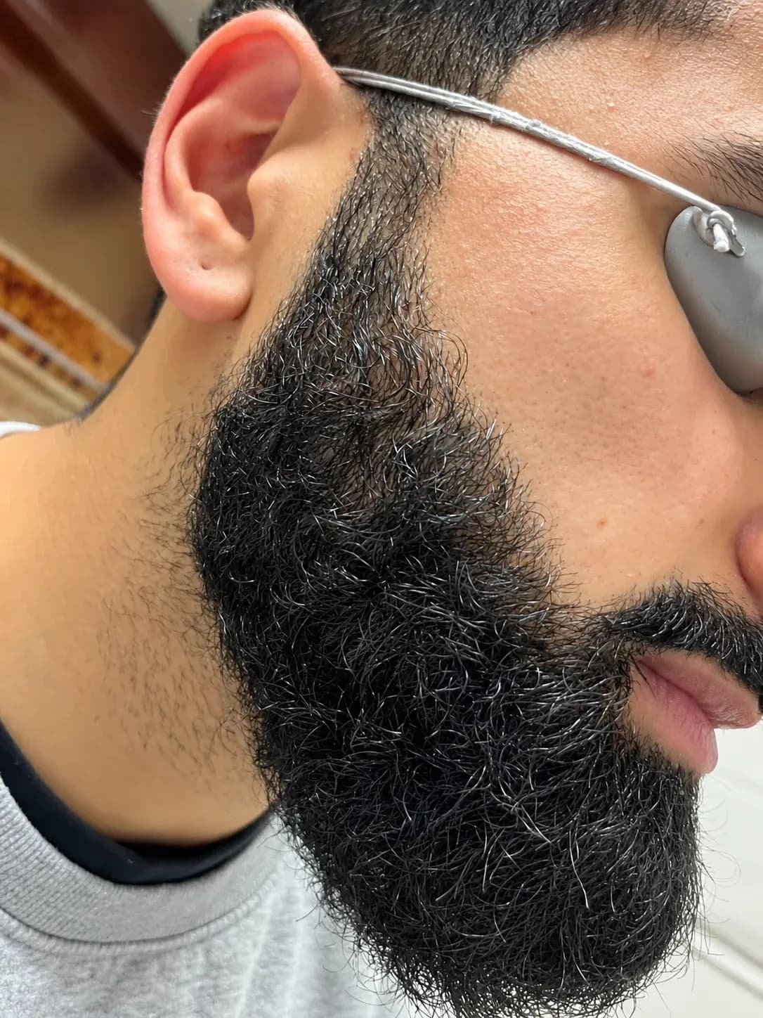After 2 laser hair removal sessions showing visible reduction in facial and beard-area hair growth.