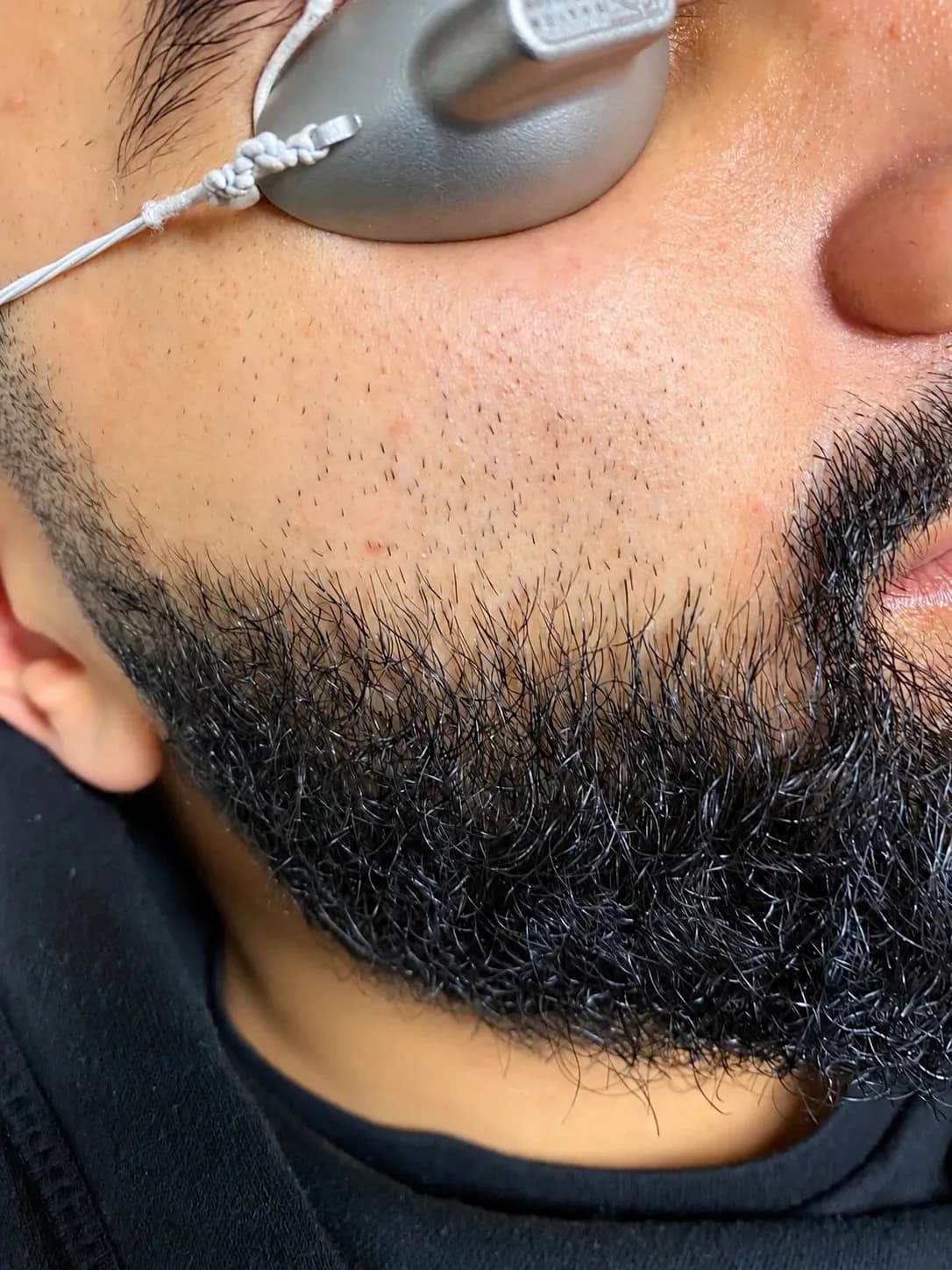 Before laser hair removal showing visible facial and beard-area hair growth.