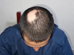 Alopecia Areata Treatment treatment at Paradise Wellness