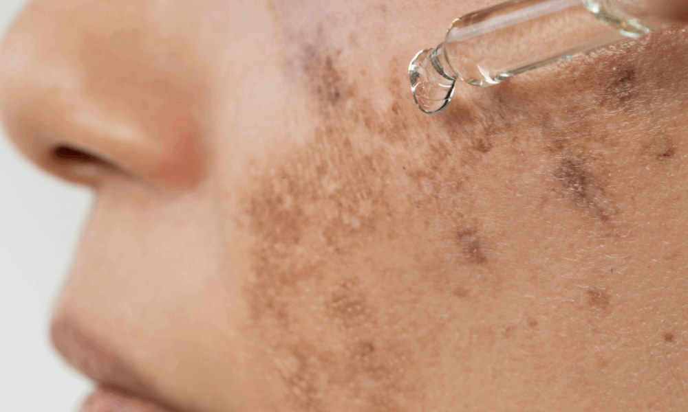 Best Treatment for Pigmentation: 5 Reasons BioRePeel Beats Chemical Peels for Glowing Skin