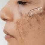Best treatment for pigmentation using medical-grade skincare and technology