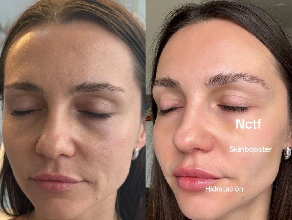 NCTF Skin Booster Before And After Results